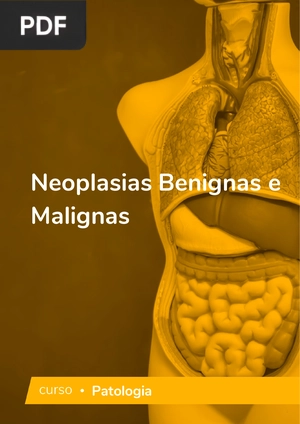 Neoplasias Benignas e Malignas (Artigo)